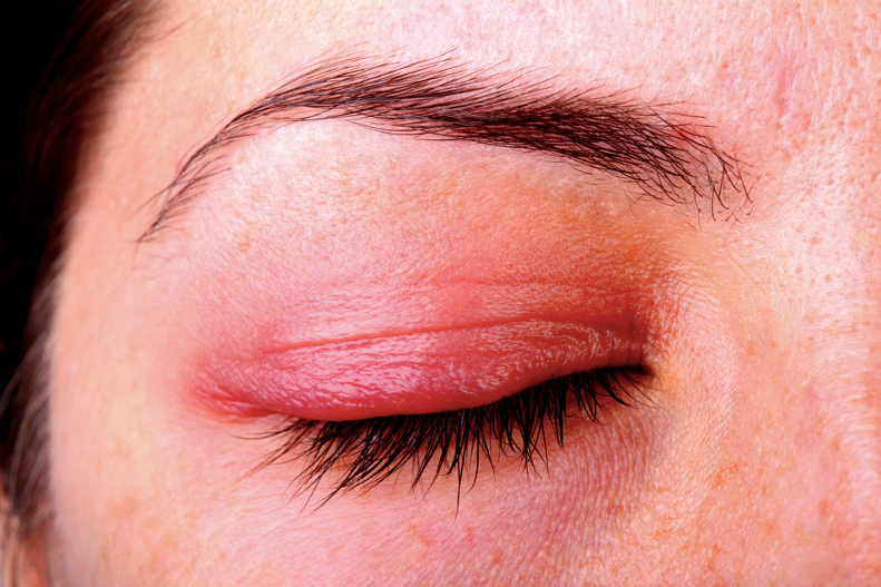 Ocular-Rosacea|eye-2274884_1280