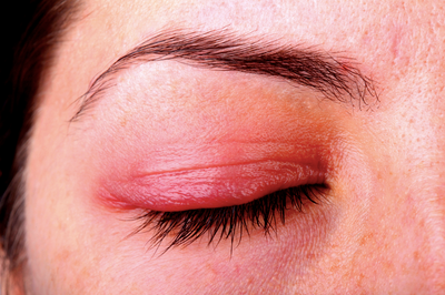 Rosacea and Ocular Rosacea Eye Issues