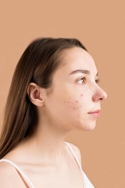 What is acne?