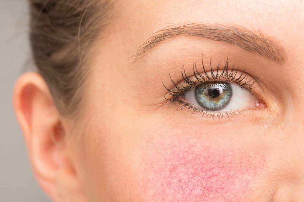 Cosmetic Treatment of Rosacea