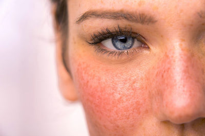 What Causes Rosacea?