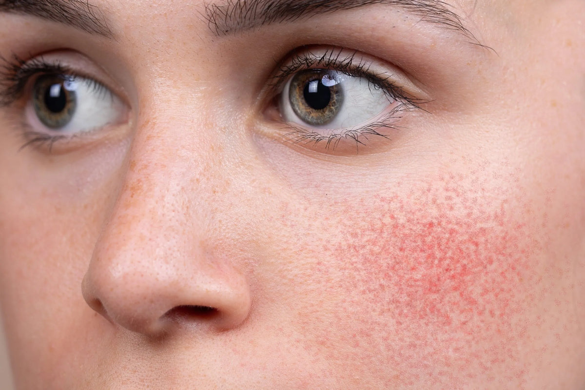 Harnessing the Power of Sulphur to Reduce Skin Inflammation