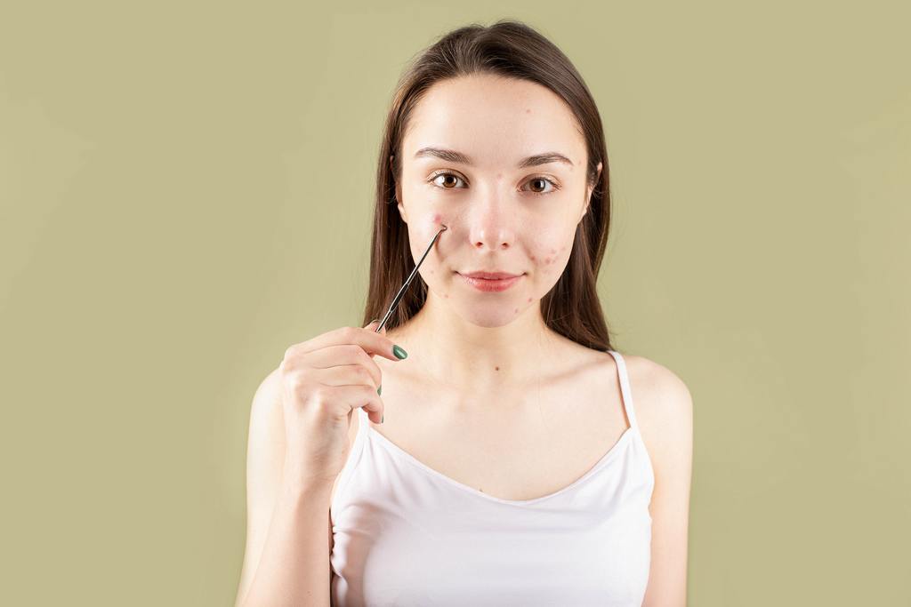 MSM Skincare Australia for acne relief