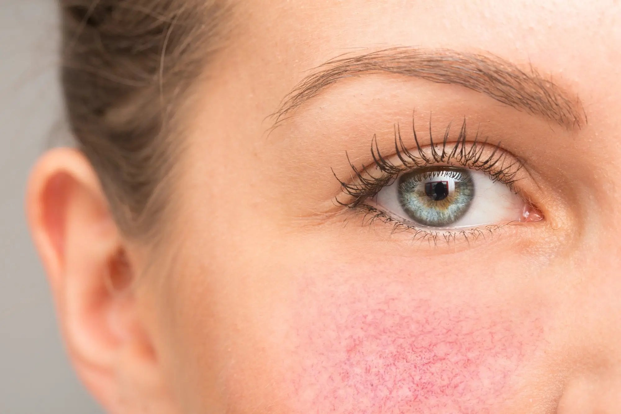 Rosacea and how to deal