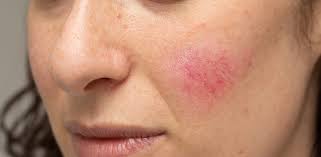 MSM Skincare Australia for Rosacea or Sensitive skin
