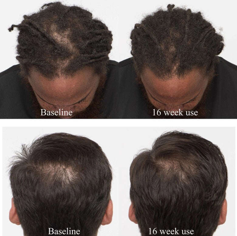 MSM Curing Baldness?