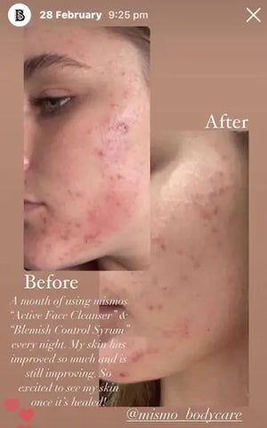 What Acne Sufferers Should Avoid