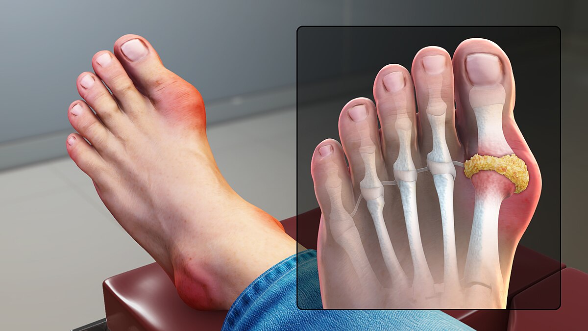 MSM For Arthritis